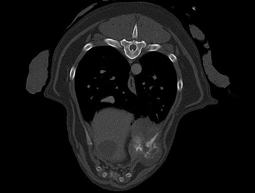 Tumor Rippe CT
